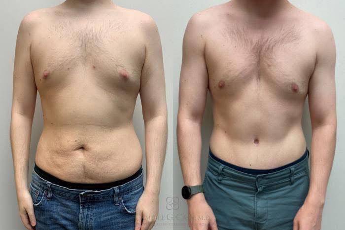 Body contouring result